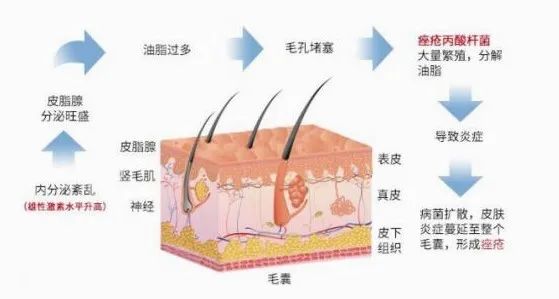 痤疮,痤疮丙酸杆菌,炎症,毛囊皮脂